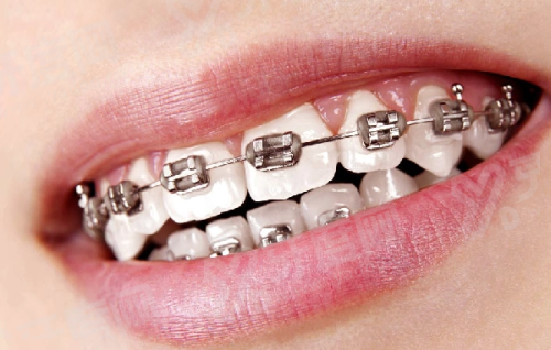 瑞士Tplus种植体是正规还是仿？正规高端种植体，优点多价格4500起一颗