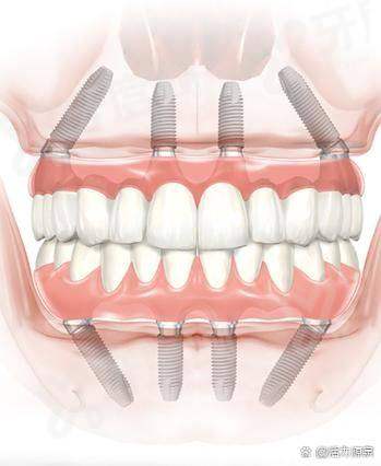 二、广告种植牙3999有效 果吗?