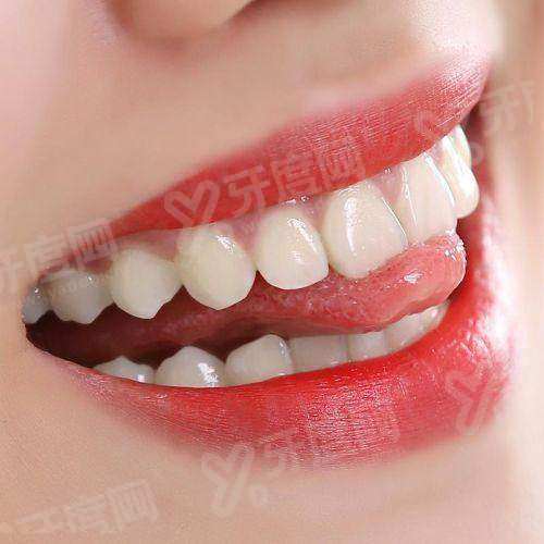 广告种植牙3999元怎么样？性价比高，中诺/拜博/美奥/牙博士种植效果好可信！