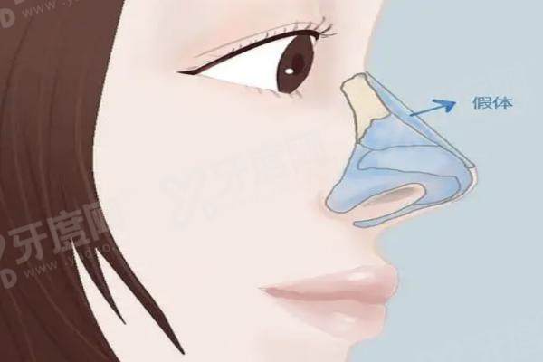 连凯峰医生隆鼻多少钱？北京连凯峰隆鼻价格：硅胶假体1.5万+肋软骨鼻综合4-8万+