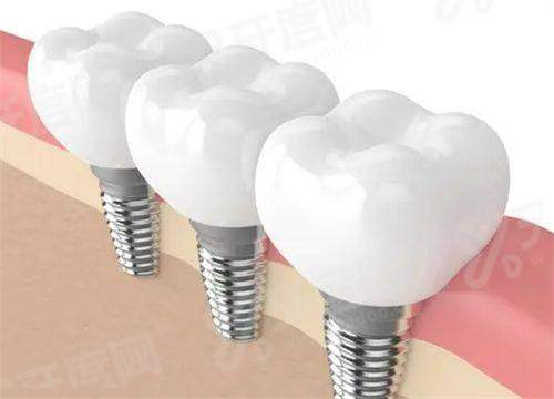 二、osseospeed种植体怎么样？