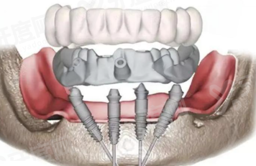 一、osseospeed种植体是什么牌子?