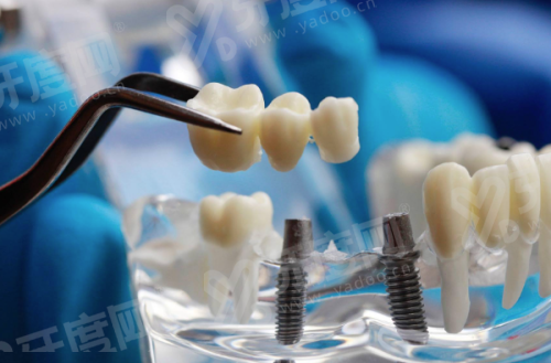 三、osseospeed种植体型号及特点：