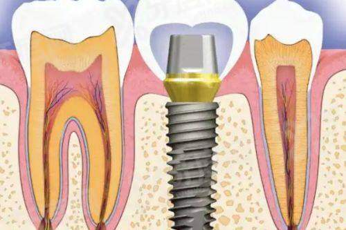 我带了40年活动义齿感受，亲测三种假牙舒适度！附500元起/颗活动义齿价格表 