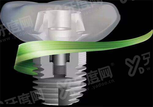 三、活动假牙价格表：