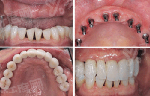 二、活动假牙哪种舒服？