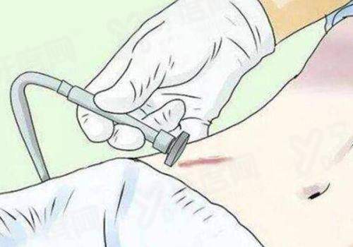 乳房再造手术需要多少钱？国产2w/进口3w元起，揭秘缺点和优点！