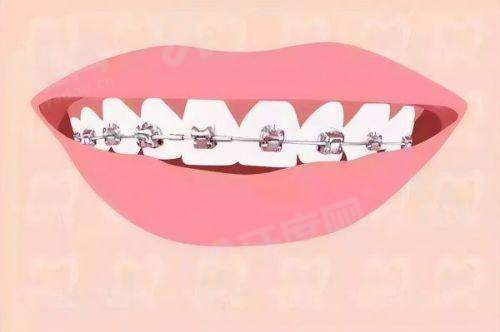 瑞士tplus种植体集采了吗