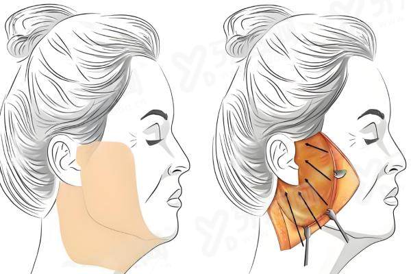 北京谢宏彬拉皮手术价格表2026更新：大拉皮8万起，效果能维持8年以上