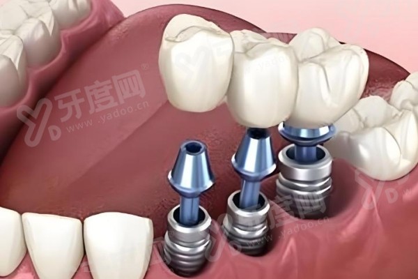 士卓曼blt钛锆合金种植体一颗得多钱？1.6万-3.2万元左右，质量可靠、修复咀嚼功能超棒！ 