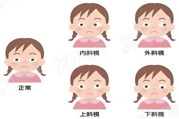 斜视.jpg