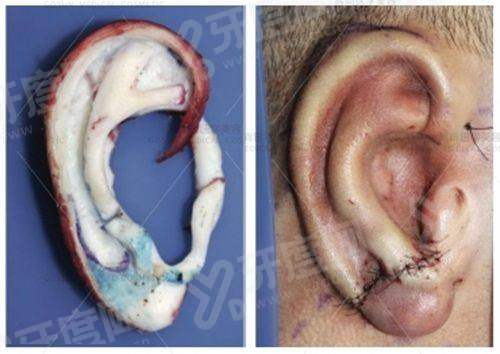 曼微羽玻尿酸多少钱一支？0.5m装1500元起/1ml装2800元起！