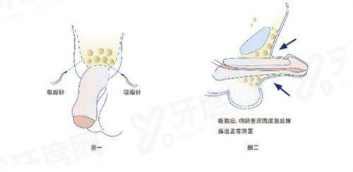 二、武晓莉医生去疤痕怎么样？