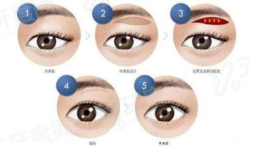 莫志波做的鼻综合多少钱？小鼻综合5k/大鼻综合2W元起！