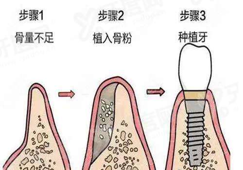 科惠种植体是杂牌还是名牌？是国产品牌，和奥齿泰通不通用，价格1980元起一颗