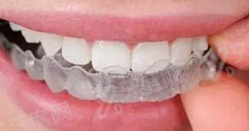 韩国迪耀和八维种植体哪个好?迪耀性价比高/八维美学效果更好