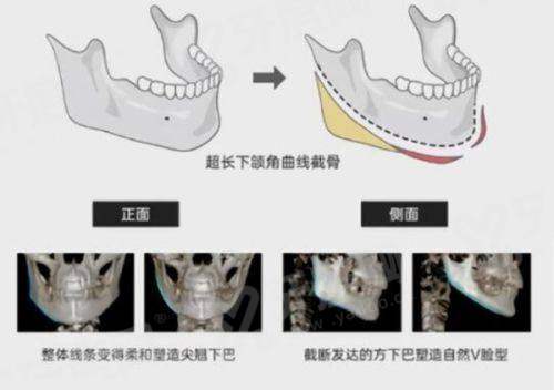 王恒双眼皮修复是包装的吗？绝非包装！王恒成功修复超5000例，坐诊北京睐美安等医院，地址速戳！