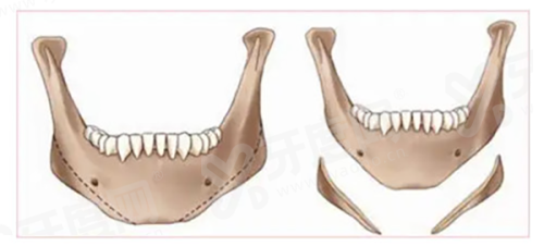 张本军上海汇壹美取因子效果怎么样？实测效果惊艳，提取价格16800起，坐诊地址在徐汇区淮海中路