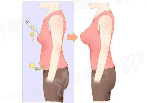 成都哪个医生做筋膜提升手术靠谱？推荐李建钢/杨迪/蒲兴旺等口碑医生