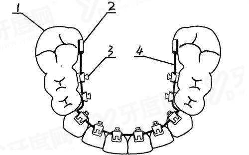 维钛种植体优点