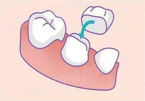 维钛种植体是属什么档次的品牌