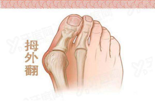 马桂文大脚骨真的有那么神奇吗？98%无神经损伤，价格1.68W起值得做