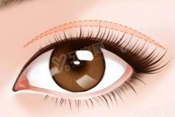 沈阳杏林张莹莹双眼皮修复怎么样？专攻肉条 / 宽改窄！效果妈生感十足，价格透明无套路！