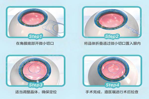 1765181389292921.jpg 近视6.jpg