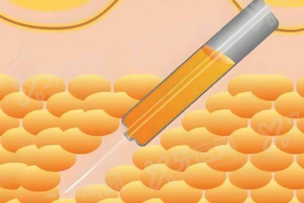 深圳阳光整形医院吸脂手术谁做的最好？陈群医生做吸脂手术好且稳附吸脂收费标准