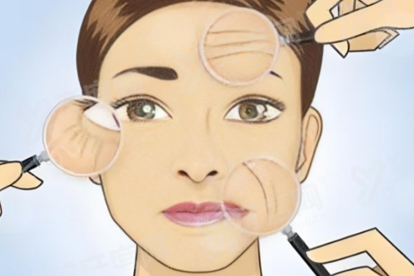 上海赵寅局拉皮价格表：面部拉皮20000+微创拉皮25000+