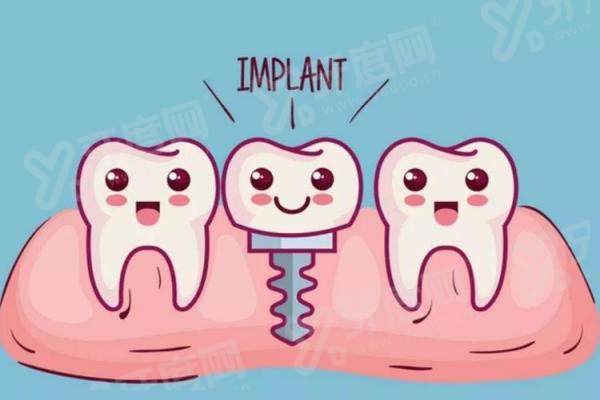 银川时光口腔种植牙效果好吗？揭秘其“即刻负重”与“微创种植”技术，附价格表与中心地址。