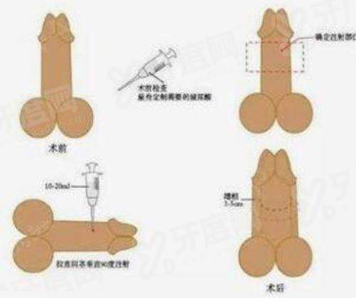 成都华生铂悦王欣做腰腹吸脂多少钱？腰部/腹部吸脂1.38w+ / 马甲线雕刻1.36w+ / 男士腹肌雕刻1.88w+ 