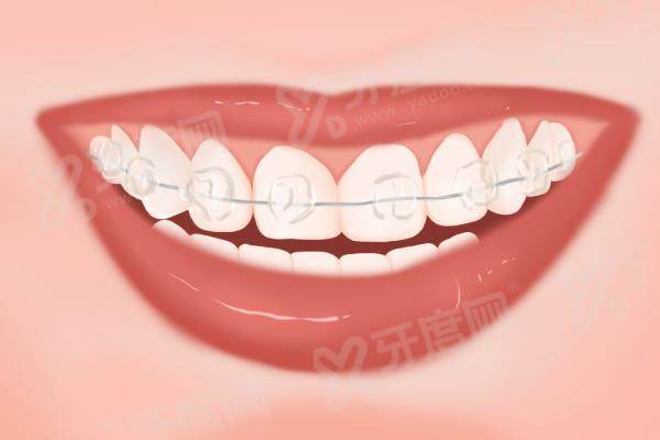 北京禾禾口腔门诊部价格表：传统金属托槽9309元起，无托槽隐形正畸12999元，各类牙套价格超实惠！ 