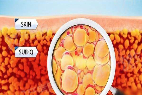 深圳曹孟君吸脂靠谱吗？当然靠谱！45天腰腹平坦马甲线显现，术后塑身衣分阶段穿时长这样定！