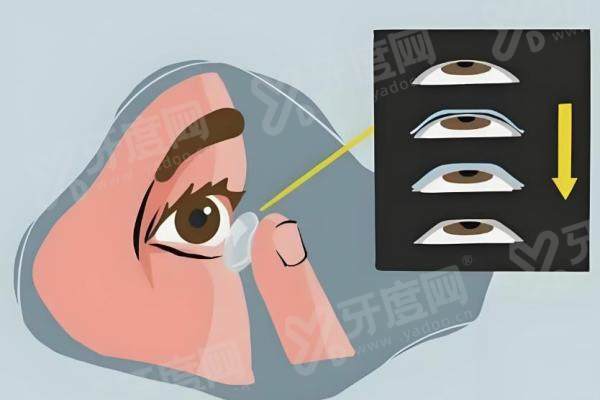 成都华厦眼科医院做白内障多少钱？白内障超声乳化术6000元起，三焦点人工晶体植入30000元起，单眼基础手术费12000元起 