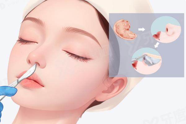 1765770424121261.jpg 肋骨隆鼻.jpg