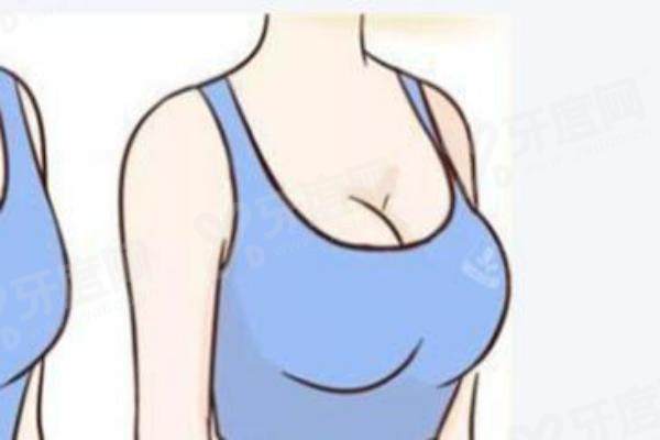 沈阳百嘉丽医疗美容医院隆胸技术怎么样？自然！自体脂肪隆胸成活率 70% 左右