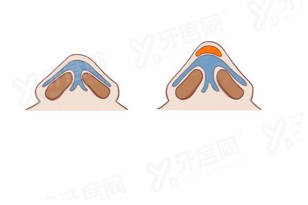 岳伟博士全维度骨雕鼻价格表：硅胶假体35000+膨体假体42000+