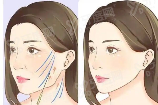 揭秘眭云鹏小拉皮手术过程？切口隐蔽、剥离精准，还有眭云鹏拉皮手术价格表解析！