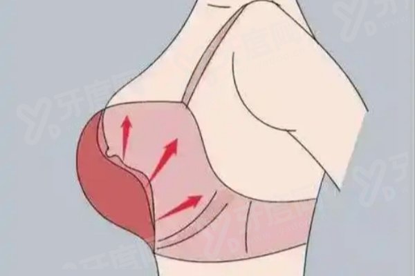 美国曼托假体隆胸北京价格一览表：基础款圆形假体30000+基础款水滴形假体32000+