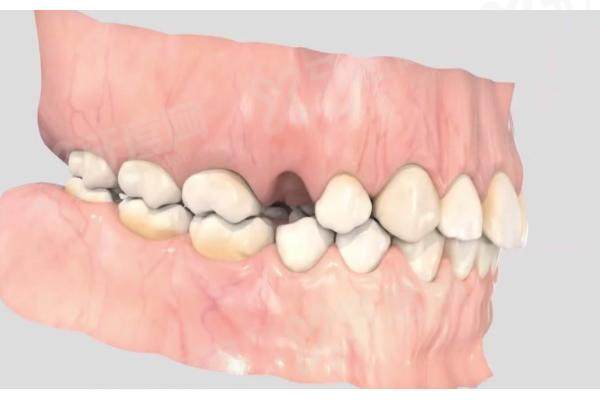 上海拜博口腔医院价格表：种植牙1980元起，牙齿矫正5000元起，拔牙98元起！ 