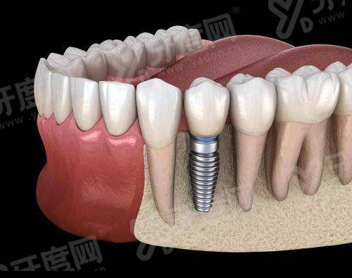 镇江装假牙哪个医院好？镇江美奥口腔|拜博口腔|康洁口腔等医院上榜