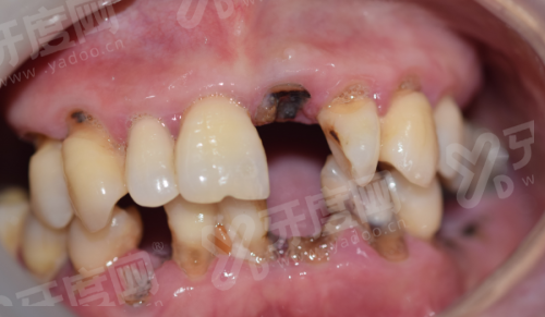 2026泌阳县华瑞口腔医院收费价格表：种植牙2980+矫正3980+镶牙800起