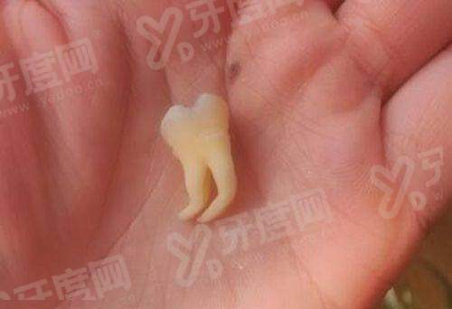 美国皓圣种植体有几个系列？2大经典系列价格表+适用人群攻略解析