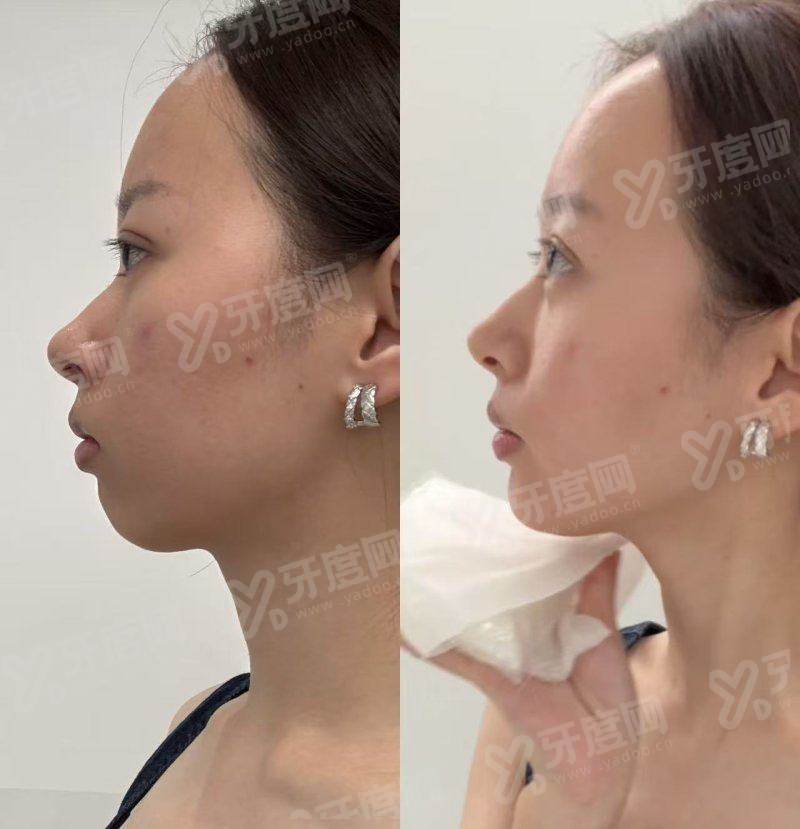 郭玉瑞医生面部提升费用：局部提升1W+/全面提升3W+元起