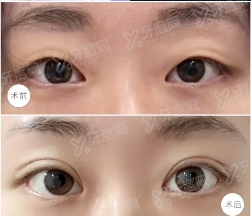 二、李欣豫双眼皮是正规医院吗yanke.yadoo.cn