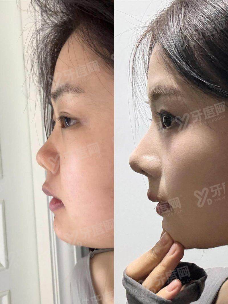 广州碧莲盛植发价格表：不剃发植发1W+/传统植发1.5W+/植眉2W+ 