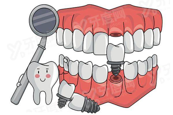 池州国康口腔种植牙怎么样？种植技术先进，价格合理，众多患者亲测效果超棒体验佳！ 