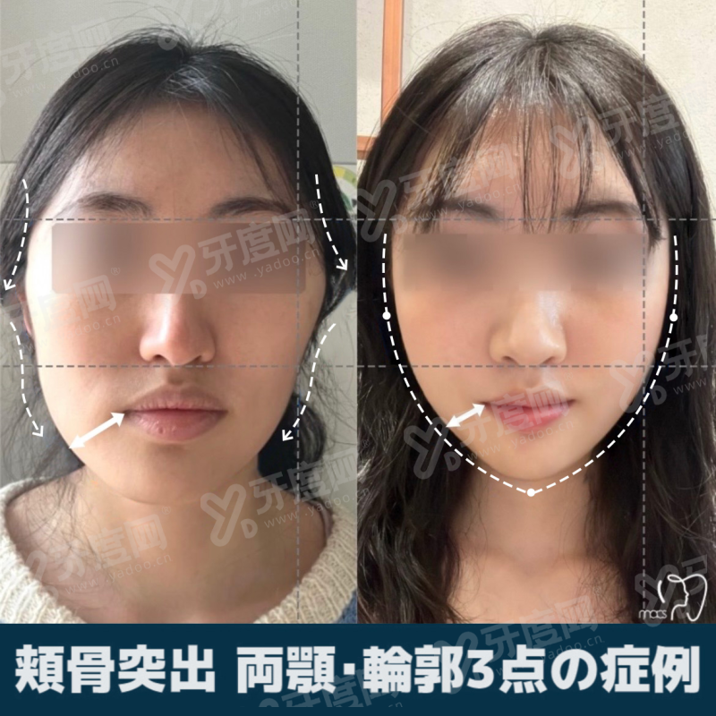 三、上海建跃口腔医院价格表？（2024年全新定价，项目收费公开透明）yanke.yadoo.cn