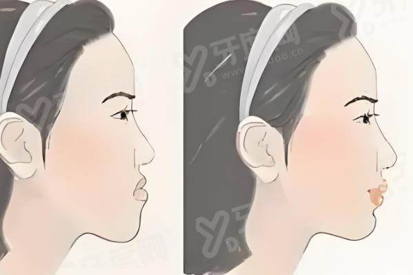 正颌正畸手术费用一般是多少钱？手术费用4~13万元起，揭秘联合治疗最佳年龄